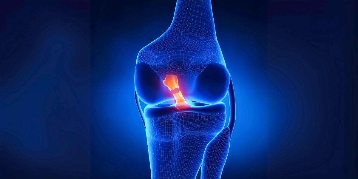 ACL ρήξη πρόσθιου χιαστού συνδέσμου