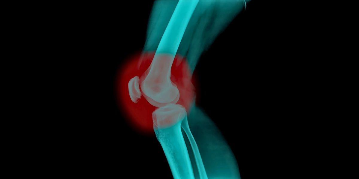 epigonatida εξάρθρημα επιγονατίδας