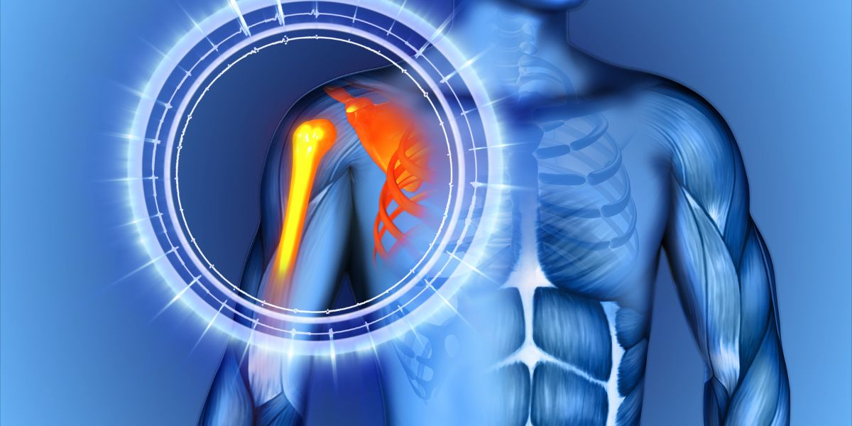 shoulder impingement σύνδρομο πρόσκρουσης ώμου