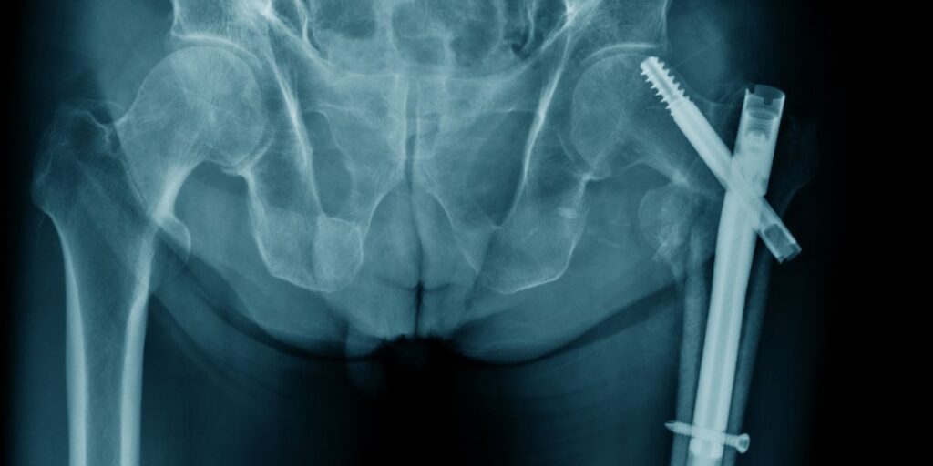 hip fracture κάταγμα ισχίου